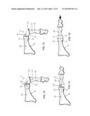 INTERMEDULLARY DEVICES FOR GENERATING AND APPLYING COMPRESSION WITHIN A     BODY diagram and image