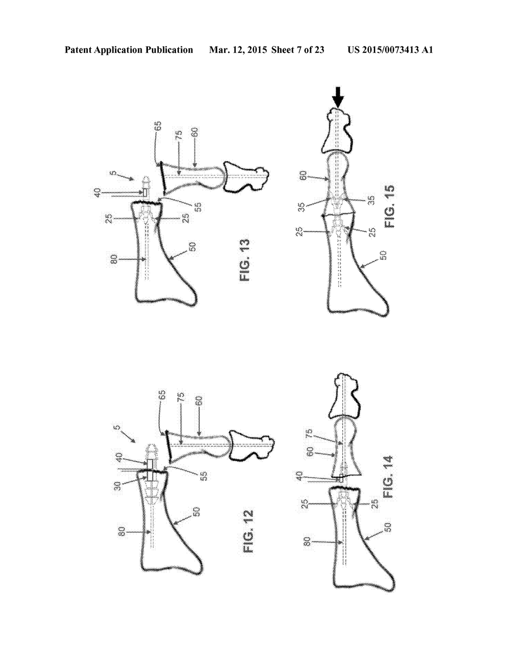 INTERMEDULLARY DEVICES FOR GENERATING AND APPLYING COMPRESSION WITHIN A     BODY - diagram, schematic, and image 08