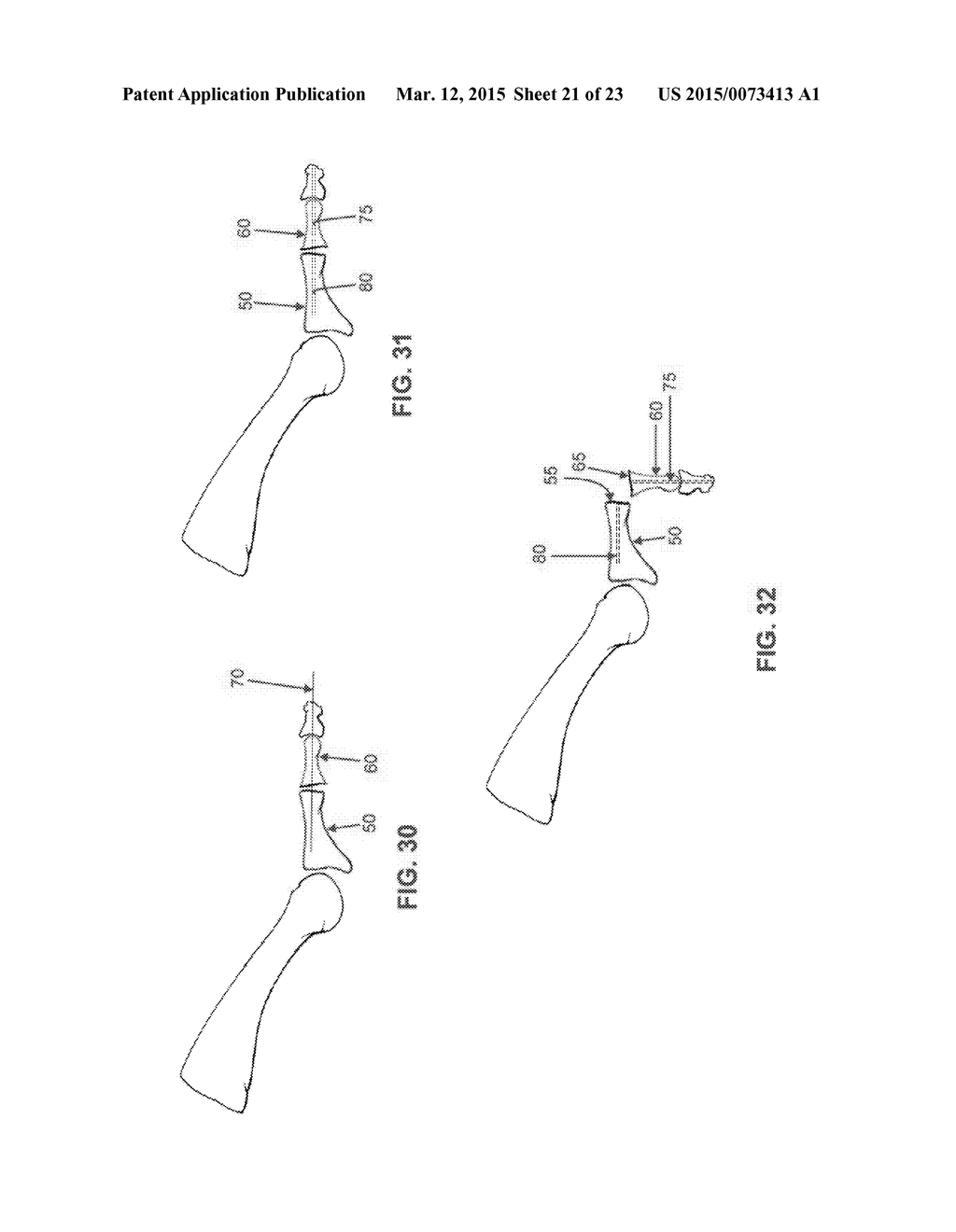 INTERMEDULLARY DEVICES FOR GENERATING AND APPLYING COMPRESSION WITHIN A     BODY - diagram, schematic, and image 22