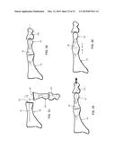 INTERMEDULLARY DEVICES FOR GENERATING AND APPLYING COMPRESSION WITHIN A     BODY diagram and image