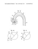 ALIGNMENT OF AN IMPLANTABLE MEDICAL DEVICE diagram and image