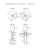 ALIGNMENT OF AN IMPLANTABLE MEDICAL DEVICE diagram and image