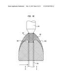 ALIGNMENT OF AN IMPLANTABLE MEDICAL DEVICE diagram and image