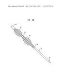 ALIGNMENT OF AN IMPLANTABLE MEDICAL DEVICE diagram and image