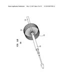 ALIGNMENT OF AN IMPLANTABLE MEDICAL DEVICE diagram and image