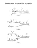 Repositionable Heart Valve and Method diagram and image