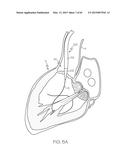 Repositionable Heart Valve and Method diagram and image