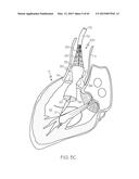 Repositionable Heart Valve and Method diagram and image