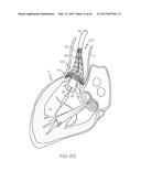 Repositionable Heart Valve and Method diagram and image