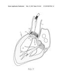 Repositionable Heart Valve and Method diagram and image