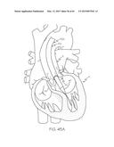 Repositionable Heart Valve and Method diagram and image