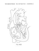 Repositionable Heart Valve and Method diagram and image