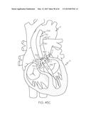 Repositionable Heart Valve and Method diagram and image