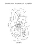 Repositionable Heart Valve and Method diagram and image