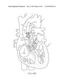 Repositionable Heart Valve and Method diagram and image