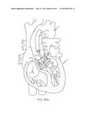 Repositionable Heart Valve and Method diagram and image