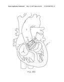 Repositionable Heart Valve and Method diagram and image