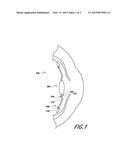 BIASED ACCOMMODATING INTRAOCULAR LENS diagram and image