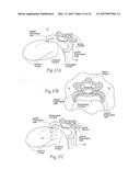 DEVICES, SYSTEMS, AND METHODS TO FIXATE TISSUE WITHIN THE REGIONS OF BODY,     SUCH AS THE PHARYNGEAL CONDUIT diagram and image