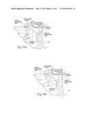 DEVICES, SYSTEMS, AND METHODS TO FIXATE TISSUE WITHIN THE REGIONS OF BODY,     SUCH AS THE PHARYNGEAL CONDUIT diagram and image