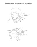 DEVICES, SYSTEMS, AND METHODS TO FIXATE TISSUE WITHIN THE REGIONS OF BODY,     SUCH AS THE PHARYNGEAL CONDUIT diagram and image