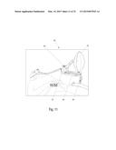 Nitrous Oxide Anesthetic Administration System diagram and image