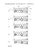 APPARATUS FOR TEMPOROMANDIBULAR JOINT-RELATED CORRECTIONS OF TOOTH     POSITION diagram and image