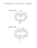 IMPLANT AND METHOD OF PLACING IMPLANT INDWELLING diagram and image