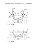 IMPLANT AND METHOD OF PLACING IMPLANT INDWELLING diagram and image