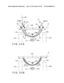 IMPLANT AND METHOD OF PLACING IMPLANT INDWELLING diagram and image