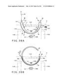 IMPLANT AND METHOD OF PLACING IMPLANT INDWELLING diagram and image