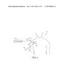 TECHNIQUES FOR DATA RETENTION UPON DETECTION OF AN EVENT IN AN IMPLANTABLE     MEDICAL DEVICE diagram and image