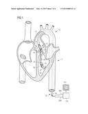 INTRAVASCULAR ROTARY BLOOD PUMP diagram and image