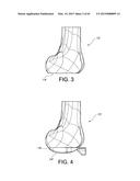 METHODS AND APPARATUS FOR PERFORMING KNEE ARTHROPLASTY diagram and image