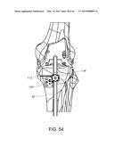 METHODS AND APPARATUS FOR PERFORMING KNEE ARTHROPLASTY diagram and image