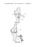 METHODS AND APPARATUS FOR PERFORMING KNEE ARTHROPLASTY diagram and image