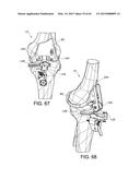 METHODS AND APPARATUS FOR PERFORMING KNEE ARTHROPLASTY diagram and image