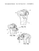 METHODS AND APPARATUS FOR PERFORMING KNEE ARTHROPLASTY diagram and image