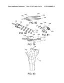 METHODS AND APPARATUS FOR PERFORMING KNEE ARTHROPLASTY diagram and image