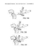 METHODS AND APPARATUS FOR PERFORMING KNEE ARTHROPLASTY diagram and image