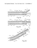 ARTICULATION FEATURES FOR ULTRASONIC SURGICAL INSTRUMENT diagram and image