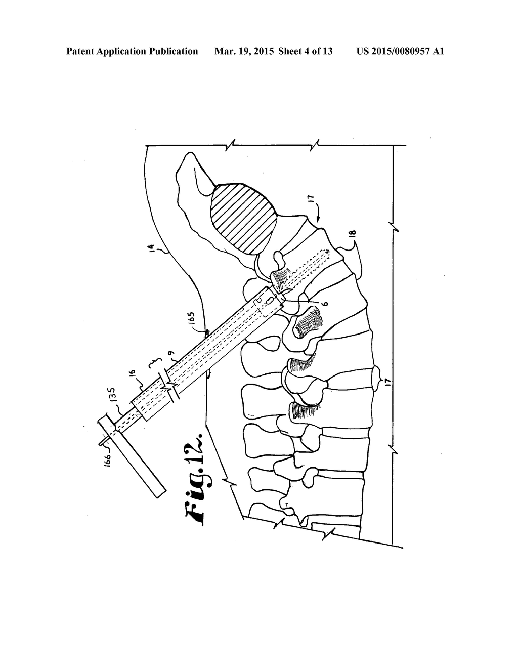 SYSTEM FOR IMPLANTING A ROD IMPLANT ALONG A SPINE OF A PATIENT - diagram, schematic, and image 05