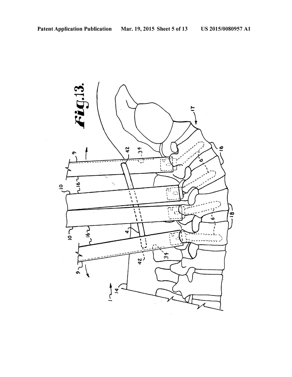 SYSTEM FOR IMPLANTING A ROD IMPLANT ALONG A SPINE OF A PATIENT - diagram, schematic, and image 06