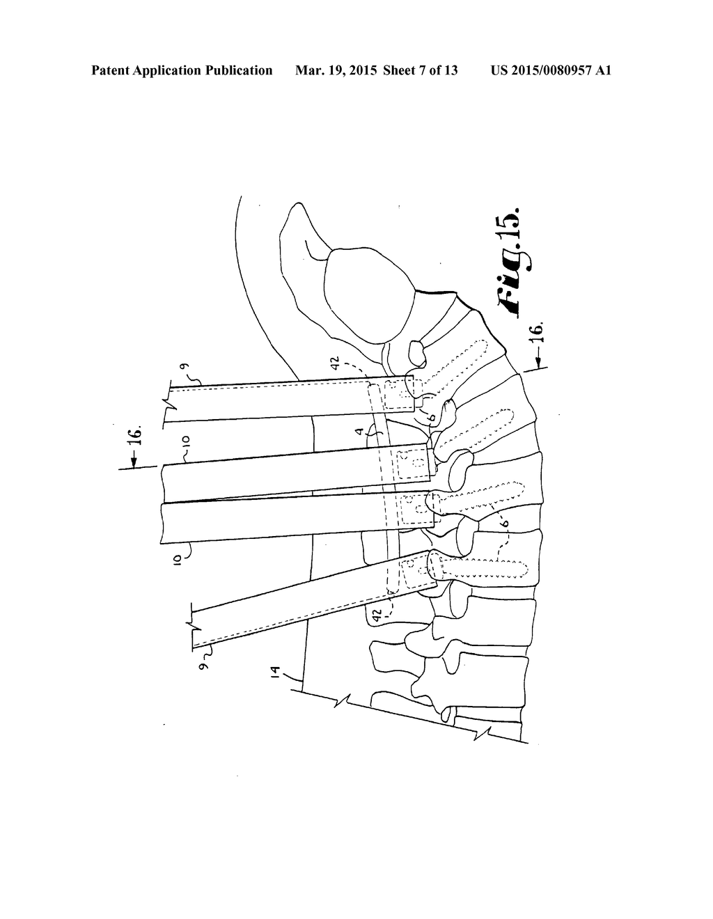 SYSTEM FOR IMPLANTING A ROD IMPLANT ALONG A SPINE OF A PATIENT - diagram, schematic, and image 08