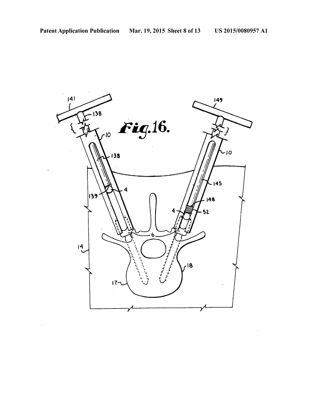 SYSTEM FOR IMPLANTING A ROD IMPLANT ALONG A SPINE OF A PATIENT - diagram, schematic, and image 09