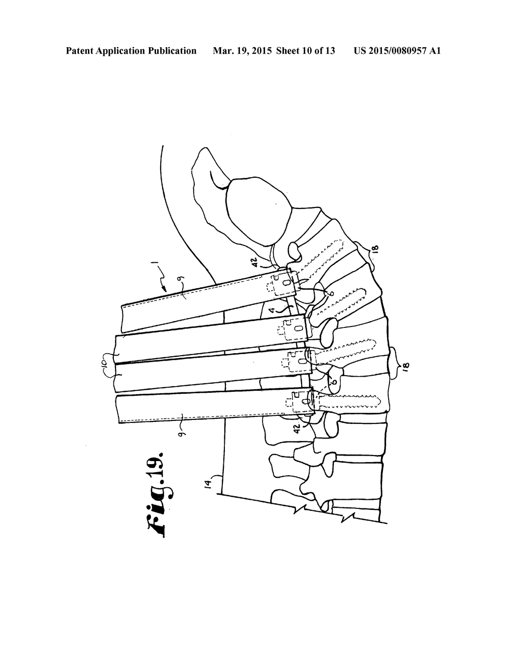 SYSTEM FOR IMPLANTING A ROD IMPLANT ALONG A SPINE OF A PATIENT - diagram, schematic, and image 11