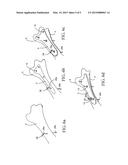 SYSTEM FOR MAKING A BONE REPAIR diagram and image