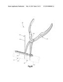 BONE FIXATION SYSTEM INCLUDING K-WIRE COMPRESSION diagram and image