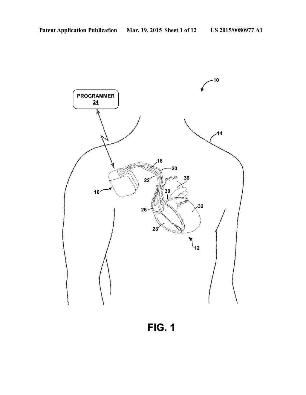 IMPLANTABLE MEDICAL DEVICE TELEMETRY IN DISRUPTIVE ENERGY FIELD - diagram, schematic, and image 02