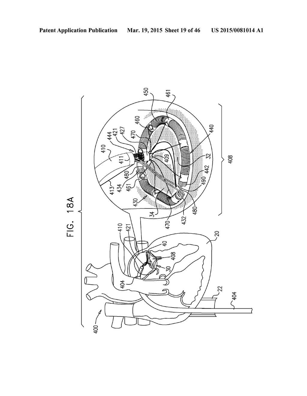 IMPLANT AND ANCHOR PLACEMENT - diagram, schematic, and image 20